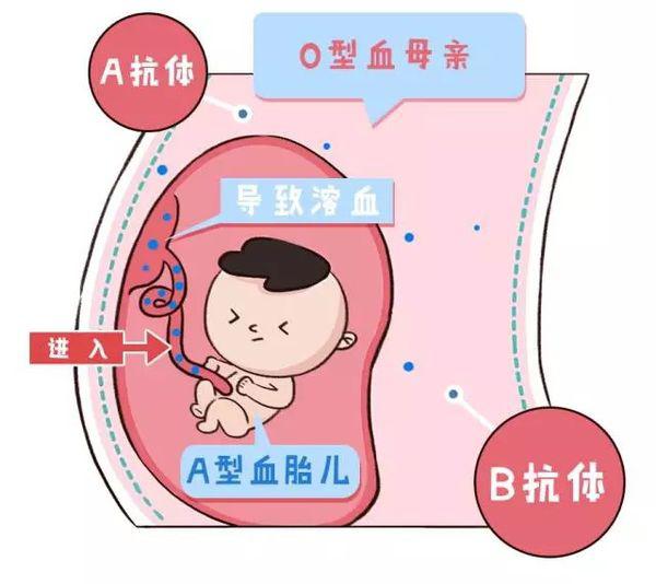 关于ABO溶血黄疸蓝光治疗回家后黄疸再现的问题解析,可靠计划策略执行_限量版36.12.29