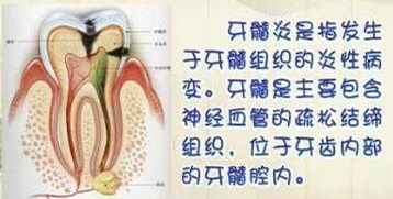 慢性牙髓炎急性发作的临床表现