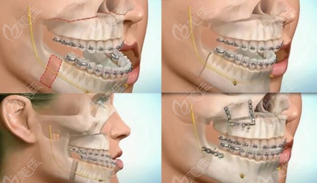 正颌正畸手术多少钱