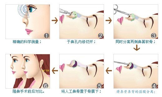 假体隆鼻疼吗 多久能恢复