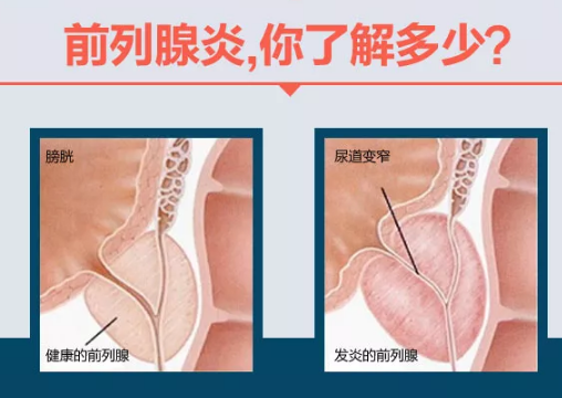 前列腺炎痛的厉害怎么办