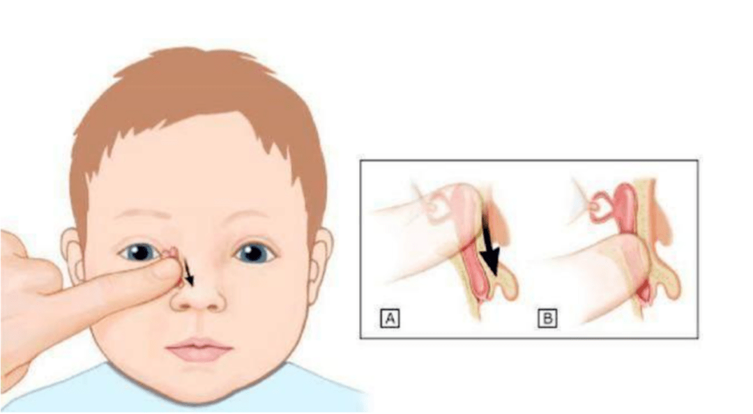 婴儿泪腺管堵塞怎么按摩图片