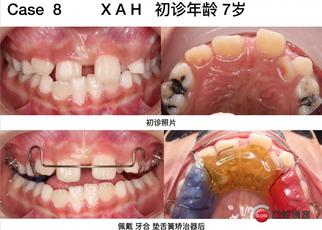 前突矫正效果