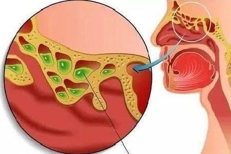 慢性鼻窦炎有哪些症状