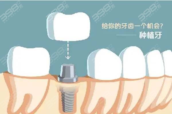 种植牙多少钱一颗2022价格表南宁医科大学附属,高效方法解析_简版29.75.57