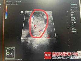 13岁男孩确诊乳腺炎非女性专属